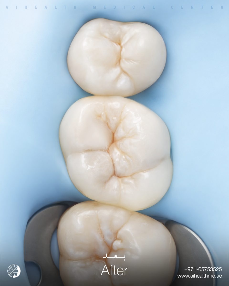 Composite Restoration