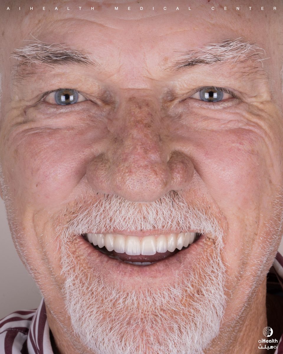 Full-Mouth Restoration
