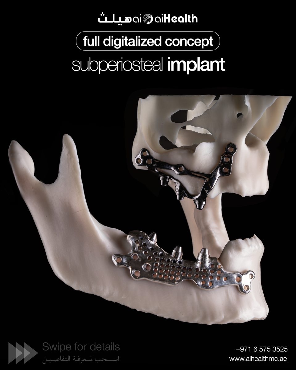 Digital Subperiosteal Implant