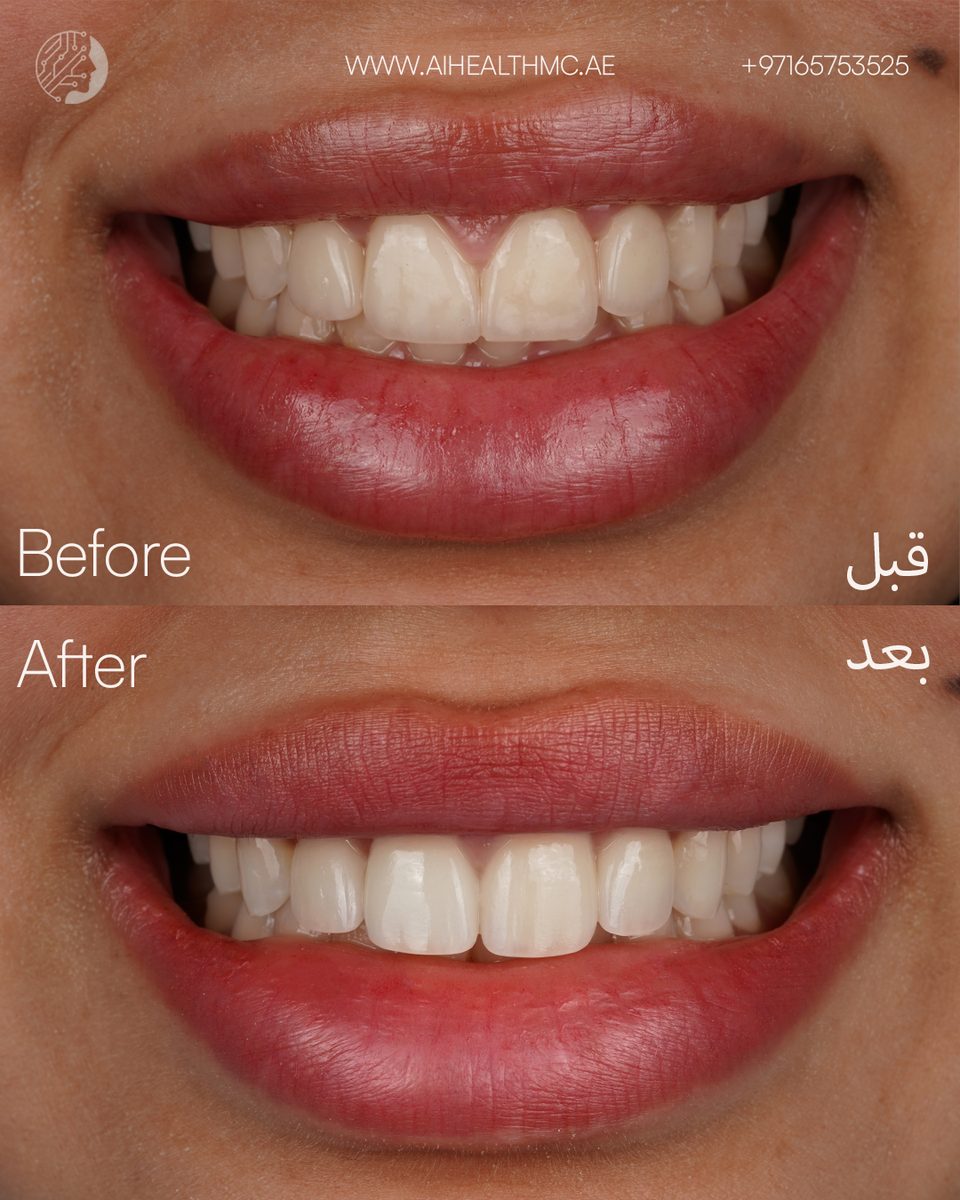 Smile Makeover — Veneer Renewal