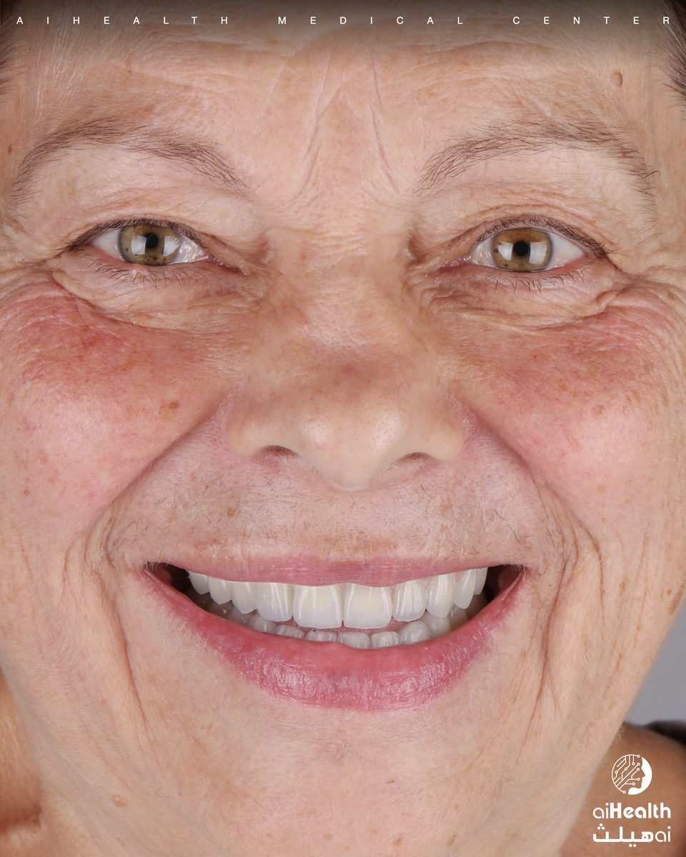 Full-Arch Implant Rehabilitation