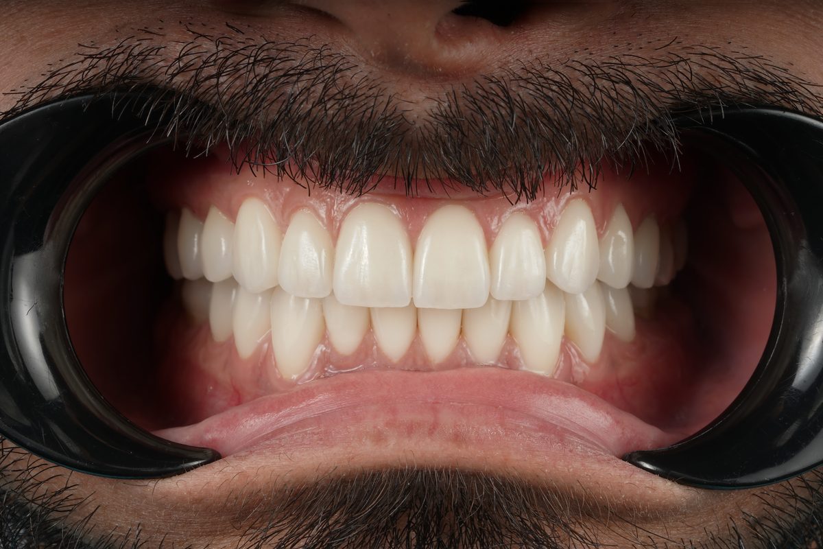 Veneers & Smile Design