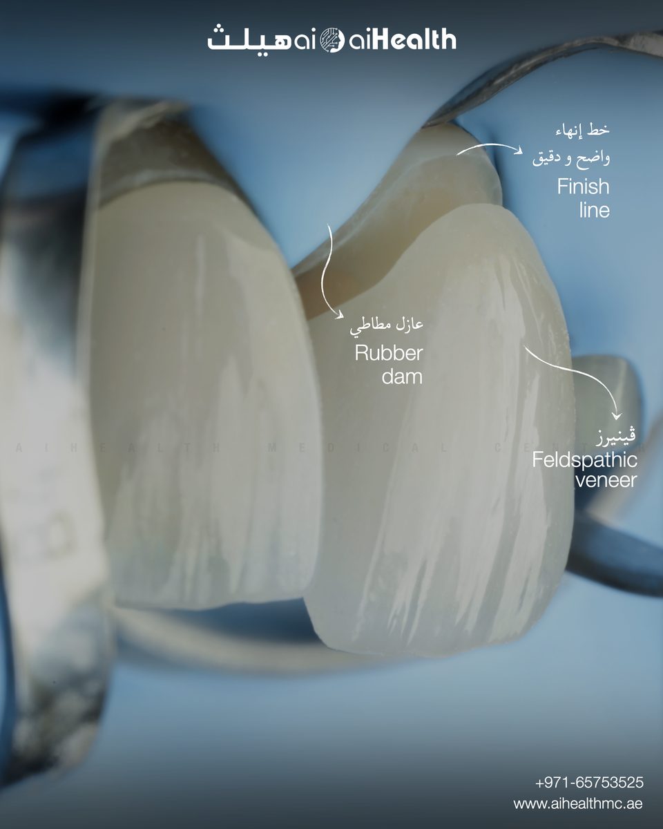 Feldspathic Veneers
